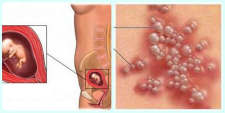 выкидыш от герпеса генитальный герпес приводит к выкидышам