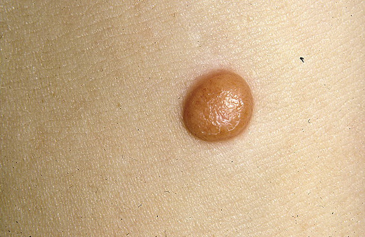 Возвышающаяся родинка Возвышение родинки над уровнем кожи