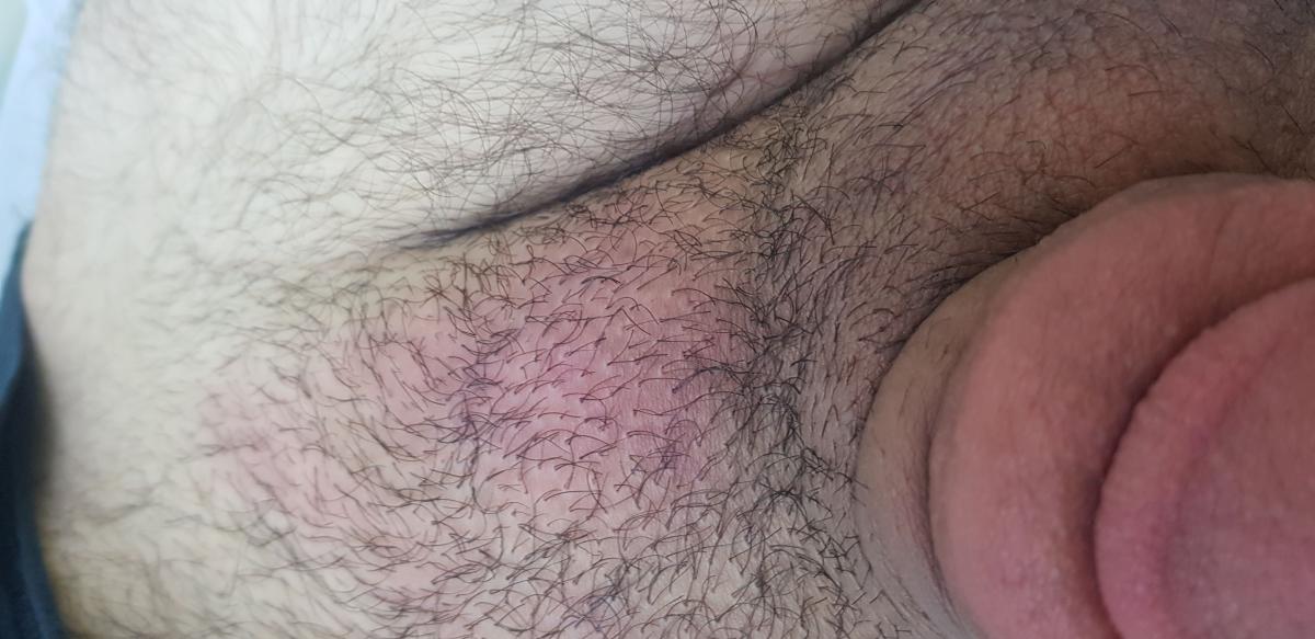 Перерождение тканей лимфатического узла Перерождение тканей лимфатического узла