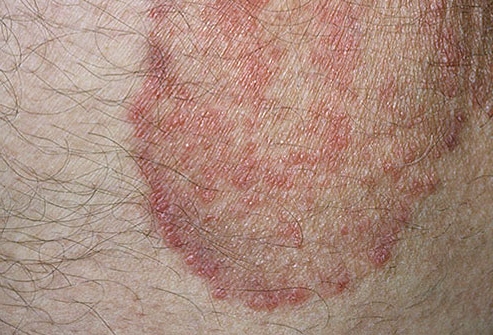 грибок в паху грибковые высыпания в паху