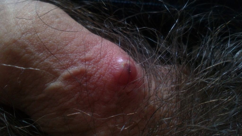 фурункул гнойный прыщ на члене у мужчин