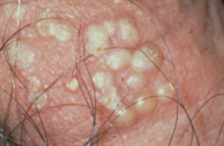 герпес пузырьки при половом герпесе